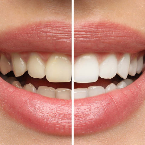 Teeth Whitening Kit