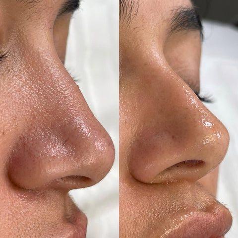 Pore Vacuum Blackhead Remover