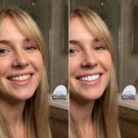 Teeth Whitening Kit